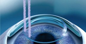 Видеоролик о лазерной коррекции зрения